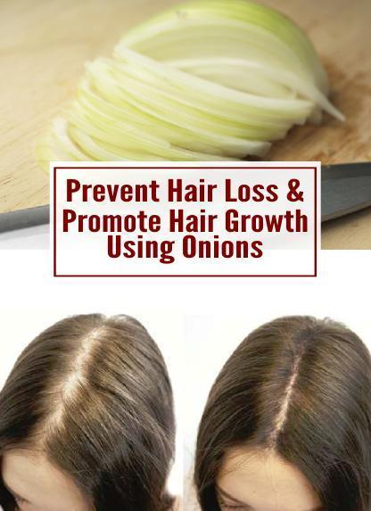 รูปภาพ:http://hairstyleshowto.com/wp-content/uploads/2016/11/Prevent-Hair-Loss-Promote-Growth-Using-Onions.jpg