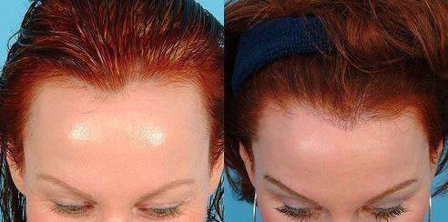 รูปภาพ:http://www.beautyclue.com/wp-content/uploads/2015/09/Before-and-after-anion-for-hair-growth-receiding-hair-line.jpg