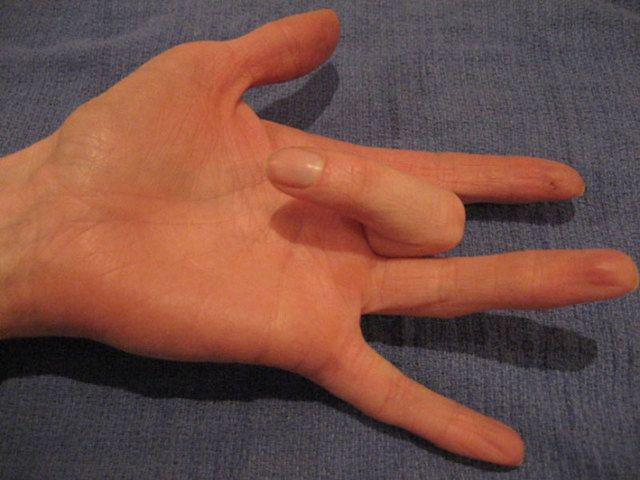 รูปภาพ:http://www.drsachintapasvi.com/images/patient_info/hand_wrist_elbow/hwe8.jpg
