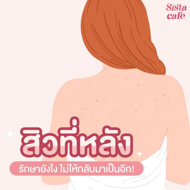 ภาพประกอบบทความ สิวที่หลัง รักษายังไง ให้หายดี ?