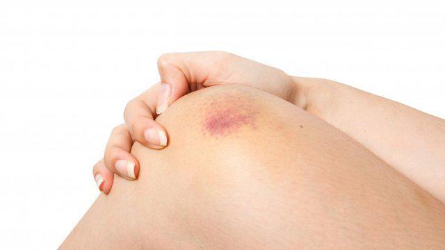 รูปภาพ:http://img2.thelist.com/img/gallery/signs-youre-not-eating-enough-veggies/you-bruise-like-a-peach-1494877203.jpg