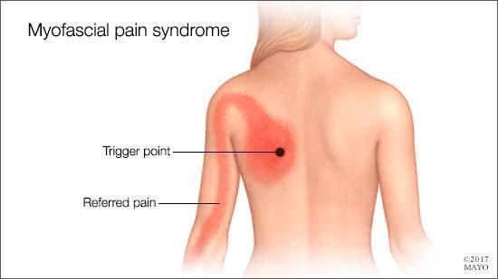 รูปภาพ:https://cdn.prod-carehubs.net/n1/802899ec472ea3d8/uploads/2017/11/a-medical-illustration-of-myofascial-pain-syndrome-16X9.jpg
