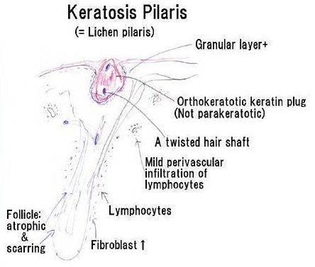 รูปภาพ:http://www.biocutis.com/wp-content/uploads/2015/07/keratosis-pilaris-diagram-granular.jpg