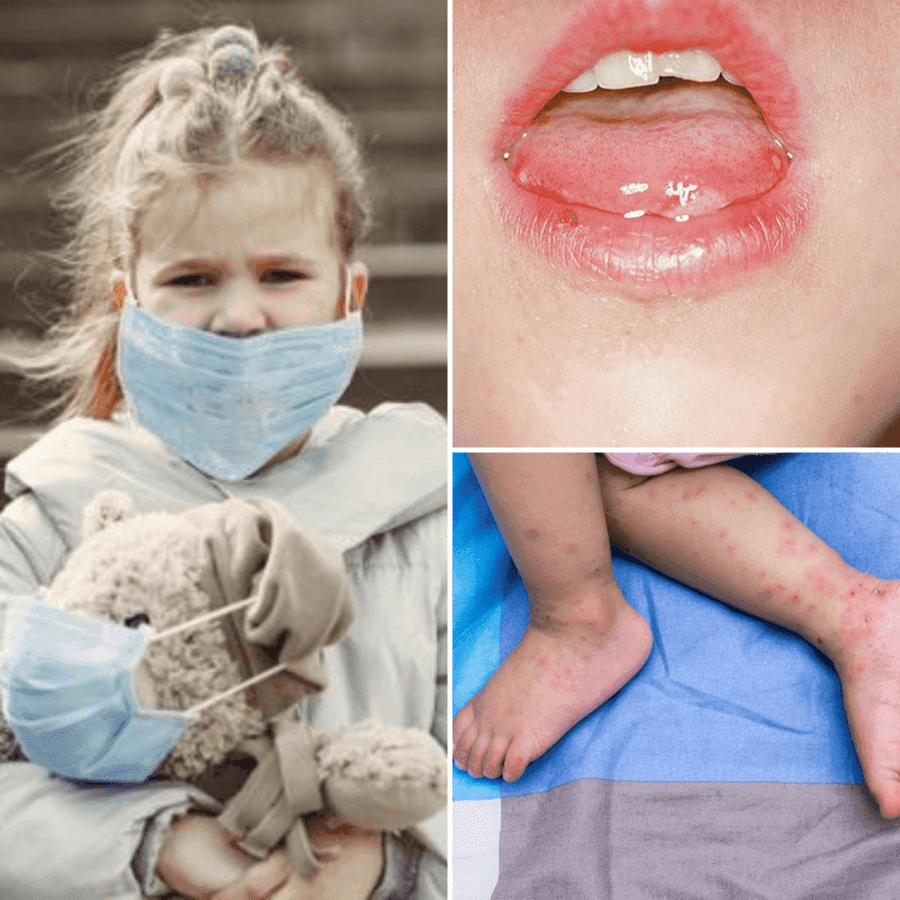 ภาพประกอบบทความ โรคมือเท้าปาก ภัยใกล้ตัวที่ต้องระวังในเด็กเล็ก เกิดจากอะไร รักษายังไงได้บ้าง?