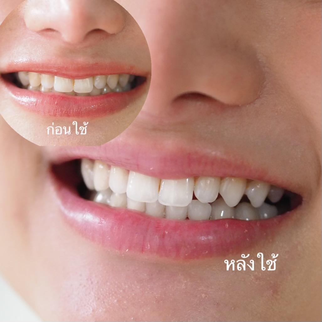 ภาพหน้าปก แปรงสีฟันโซนิค LED ฟอกฟันขาว FULI  ฟอกฟันขาวได้ง่ายๆที่บ้าน ที่:2