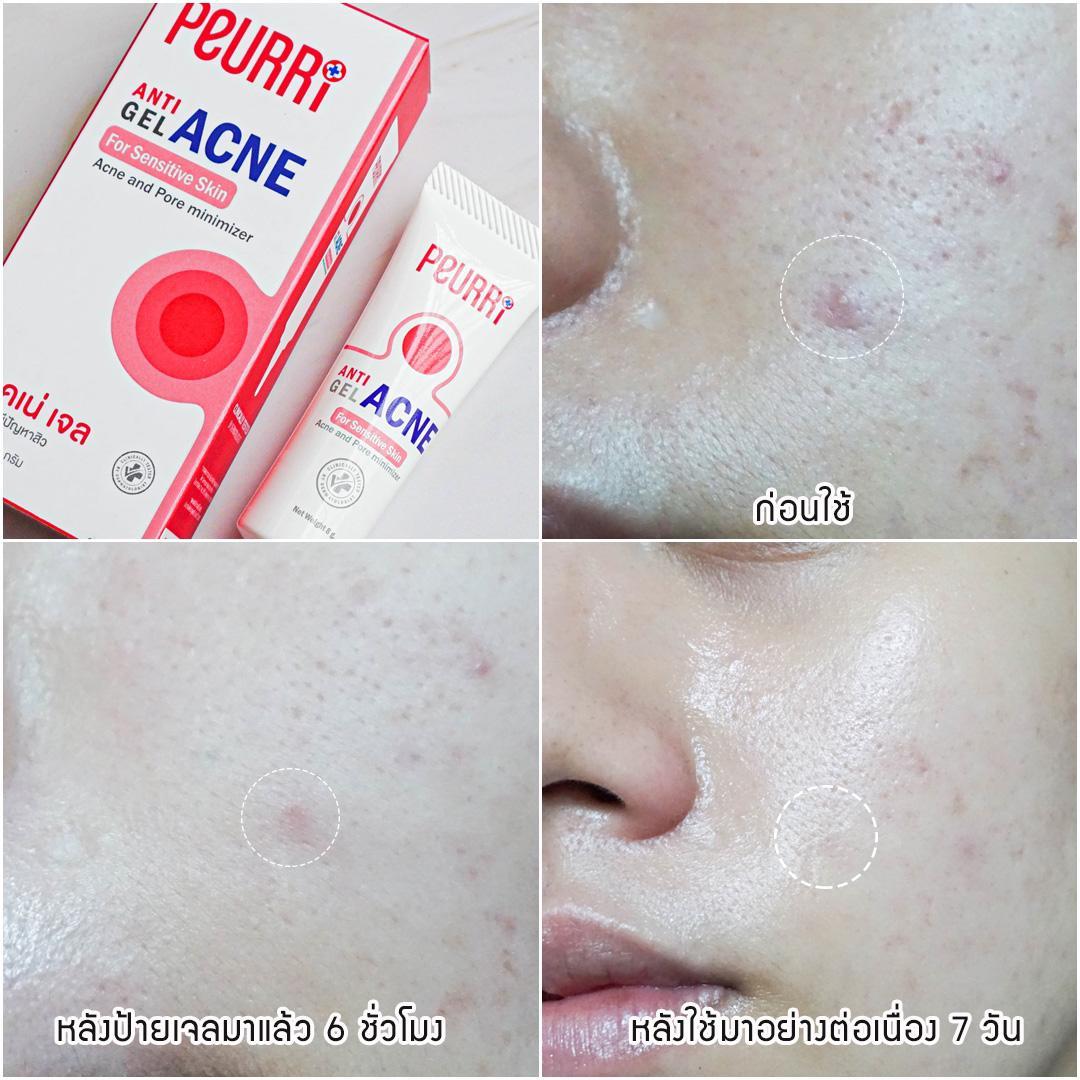 ภาพหน้าปก สิวยุบไวแค่ข้ามคืน🌙 ด้วย Peurri Anti acne gel ✨ ที่:2