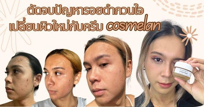 ภาพหน้าปก ตัดจบปัญหารอยดำกวนใจ เปลี่ยนผิวใหม่กับครีม cosmelan ที่:0