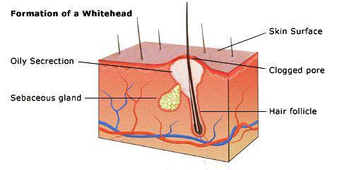 รูปภาพ:http://acner.org/img/care_and_prevention/levels-of-acne_2_3773.jpg