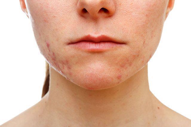 รูปภาพ:https://www.dermcheckapp.com/wp-content/uploads/2015/11/acne-vulgaris.jpg