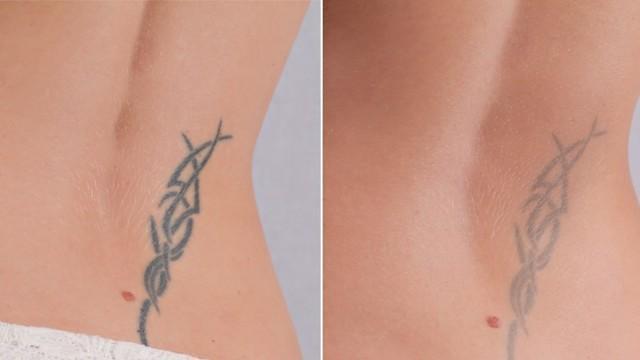 รูปภาพ:http://img4.thelist.com/img/gallery/everything-you-need-to-know-about-tattoo-removal/how-many-sessions-before-a-tattoo-is-completely-removed-1488328264.jpg