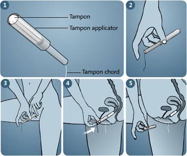 รูปภาพ:http://menstrupedia.com/assets/quickguide/hygiene/applicator-tampon.jpg