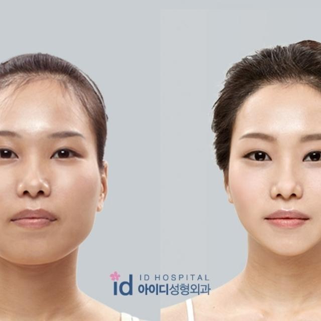 ภาพประกอบบทความ เรื่องต้องรู้ก่อนทำศัลยกรรมจมูกแบบสาวเกาหลี