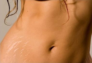 รูปภาพ:http://surgecosmetic.com/wp-content/uploads/2011/05/crack-surface-skin-thigh-laser.jpg