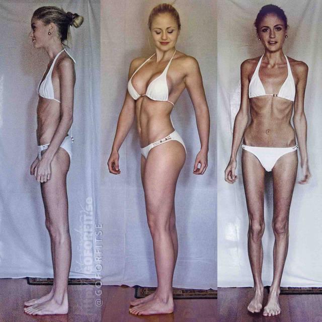รูปภาพ:http://www.trimmedandtoned.com/wp-content/uploads/2015/05/linn-stromberg-anorexia-transformation.jpg