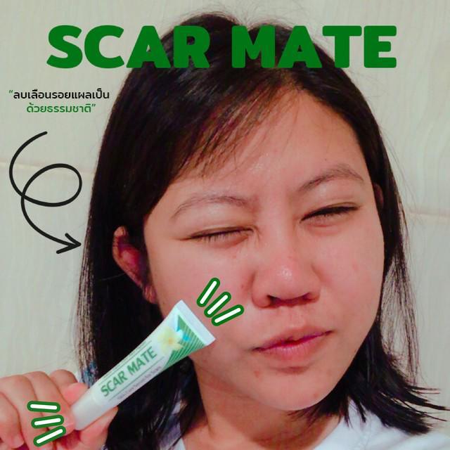 ตัวอย่าง ภาพหน้าปก:รอยแผลเป็น รอยดำ รอยแดงจากสิว รักษาด้วย Scar Mate Serum For Scars คืนผิวสวยเป็นธรรมชาติ