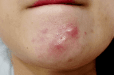 รูปภาพ:https://static.trueplookpanya.com/tppy/member/m_545000_547500/545916/cms/images/Blind-pimple-causes.png