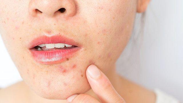 รูปภาพ:https://images.everydayhealth.com/images/skin-beauty/acne/surprising-causes-of-adult-acne-00-alt-722x406.jpg?sfvrsn=3277906e_0