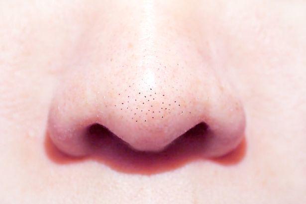 รูปภาพ:https://i2-prod.mirror.co.uk/incoming/article18334146.ece/ALTERNATES/s615b/0_close-up-macro-of-many-acne-small-blackhead-pimples-on-the-nose.jpg