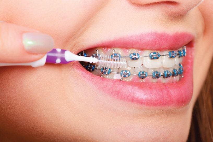 รูปภาพ:https://smileandcodentalclinic.com/wp-content/uploads/2020/11/การดูแลรักษาหลังจัดฟัน.jpg
