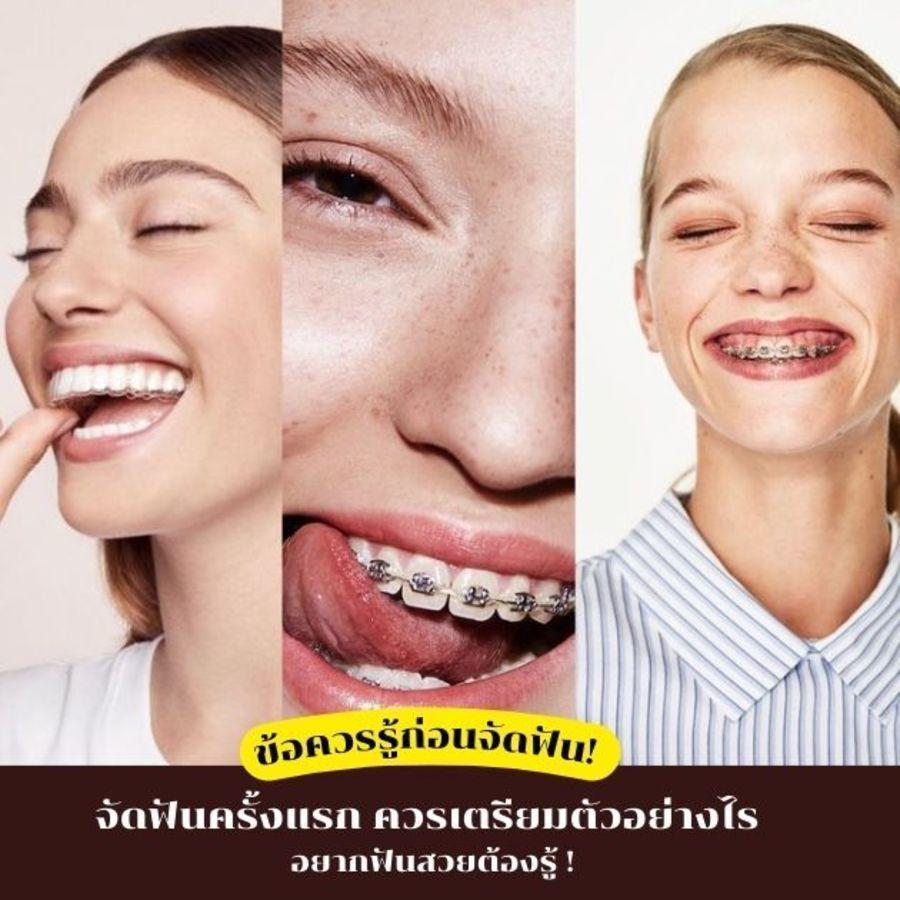ภาพประกอบบทความ จัดฟันครั้งแรก ข้อควรรู้ก่อนจัดฟันควรเตรียมตัวอย่างไร อยากฟันสวยต้องรู้ !